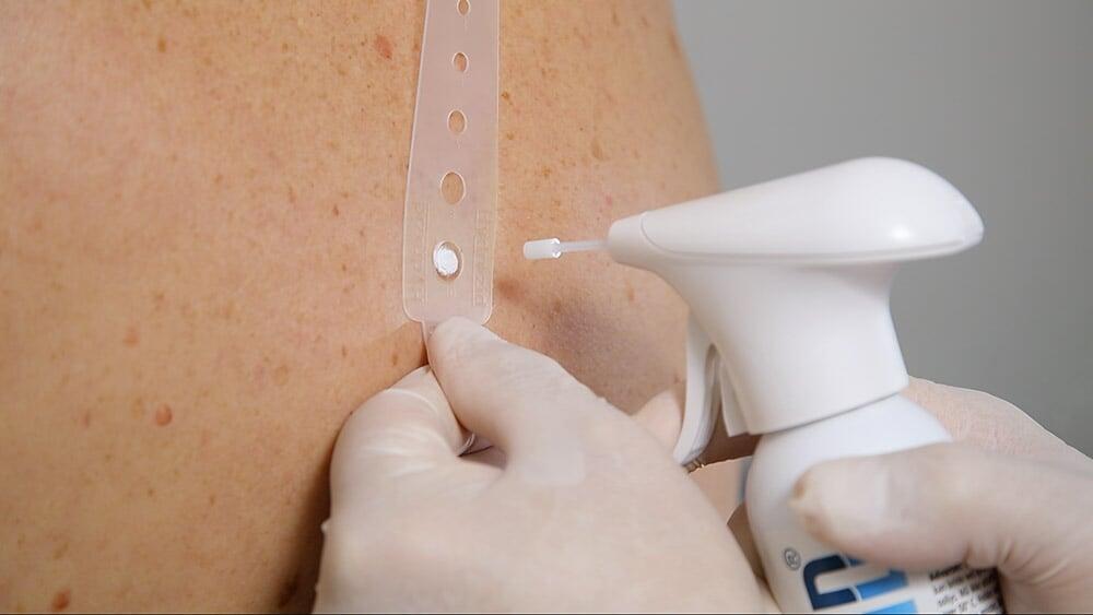 Hydrozid® Offers Simple, Effective, and Safe Cryosurgery